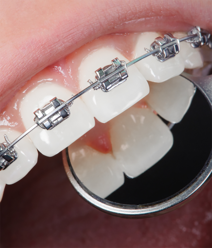 Dental Braces & Orthodontics in Nashik